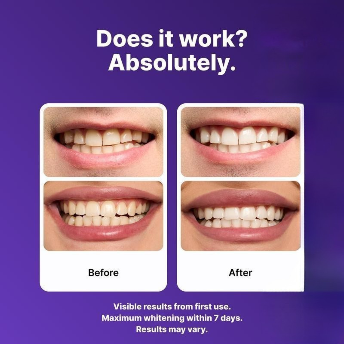 Qinqiora Whitening Strips – Achieve a Brighter, Whiter Smile in Just 7 Days!